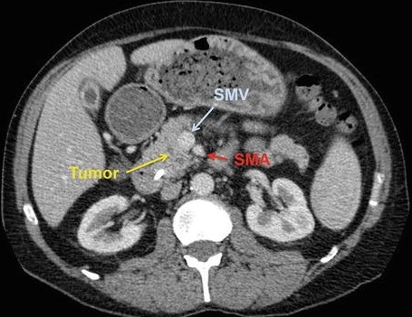 CT - Borderline Resectable Pancreatic Cancer