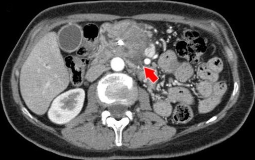 CT - Locally Advanced Pancreatic Cancer