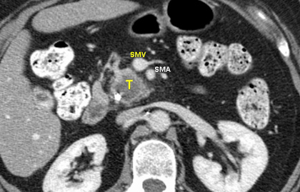 CT - Resectable Pancreatic Cancer