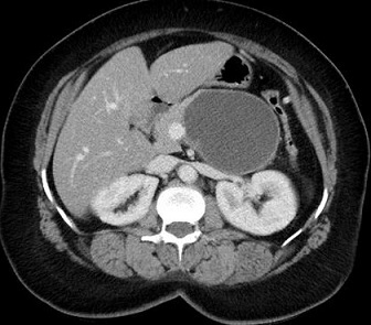 CT - Mucinous Cystic Neoplasm