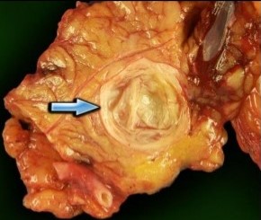 Mucinous Cystic Neoplasm - Gross