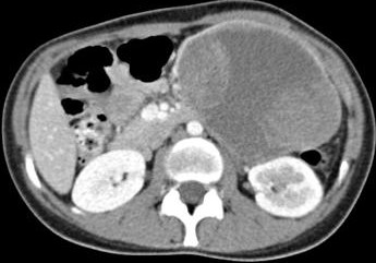 Solid Pseudopapillary Tumor - CT