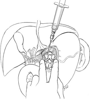 Celiac Plexus Block