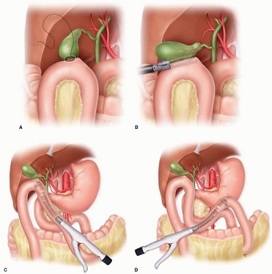 Cholecystojejunostomy and Gastrojejunostomy