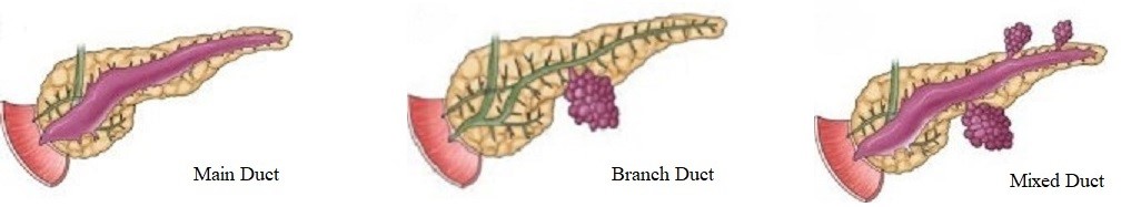 Main Duct, Branch Duct, Mixed Duct IPMNs