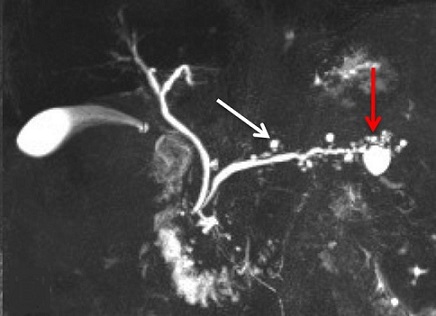 Branch Duct IPMN _ CT