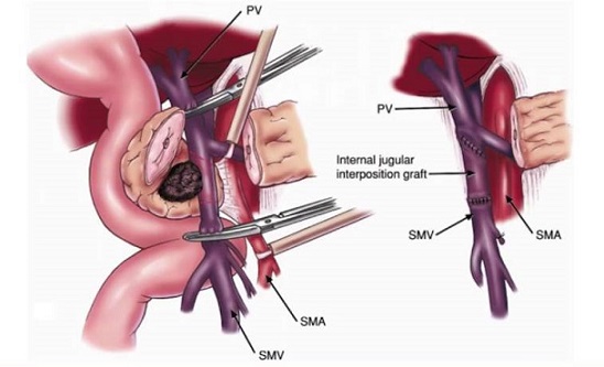 SMV/PV Excision and Reconstruction