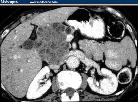 Serous Cystadenoma - CT