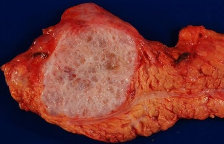 Serous Cystadenoma - Gross