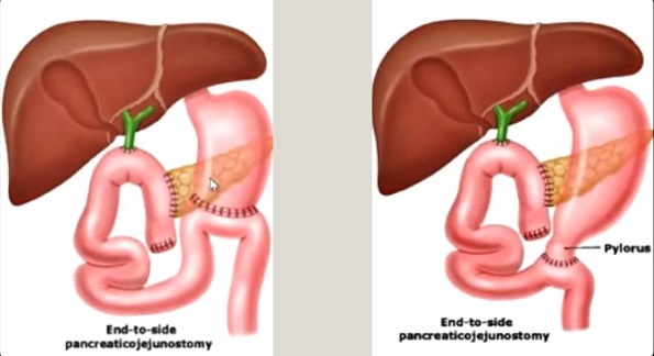 Classic and Pylorus-Sparing Pancreaticoduodenectomies