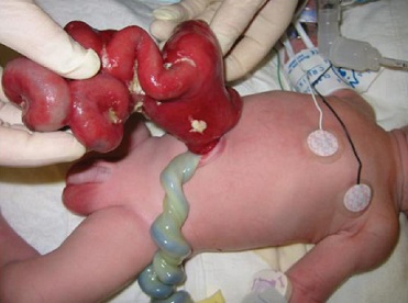 Gastroschisis