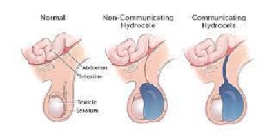 Types of Hydroceles