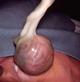 Omphalocele