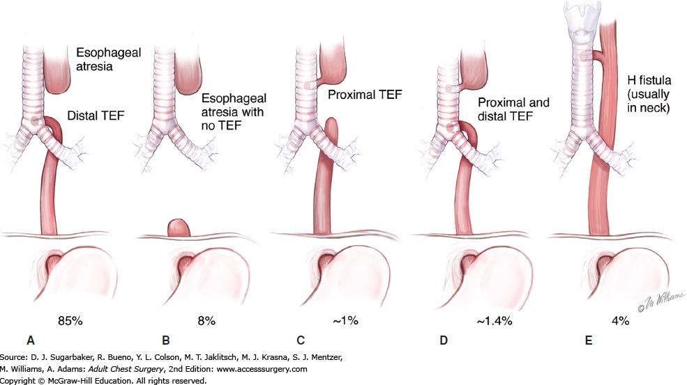 Types of Esophageal Atresia