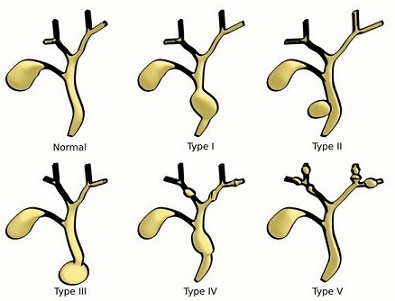 Classification of Choledochal Cysts