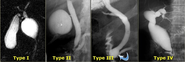 MRCP - Choledochal Cysts