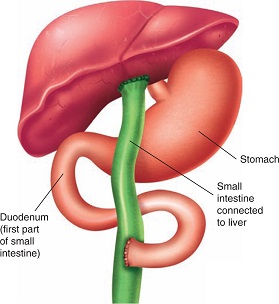 Kasai Procedure