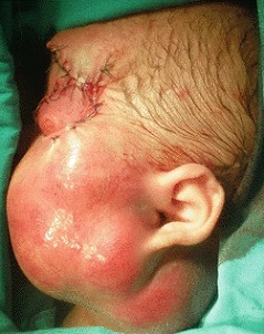 Head and Neck Rhabdomyosarcoma