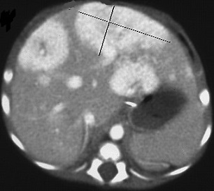 CT - Hemangioma