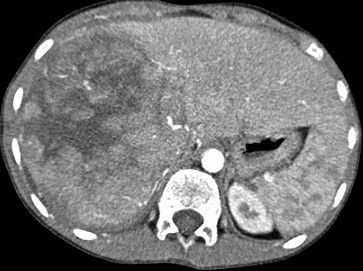 CT - Hepatoblastoma