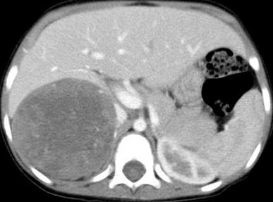 CT - Neuroblastoma