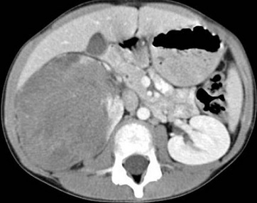 CT - Wilms Tumor