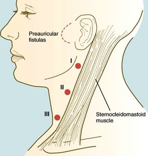 Branchial Cyst Locations