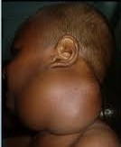 Cystic Hygroma