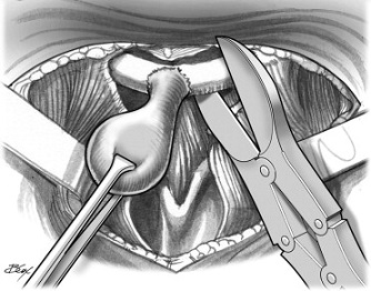 Sistrunk Procedure