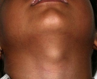 Thyroglossal Cyst