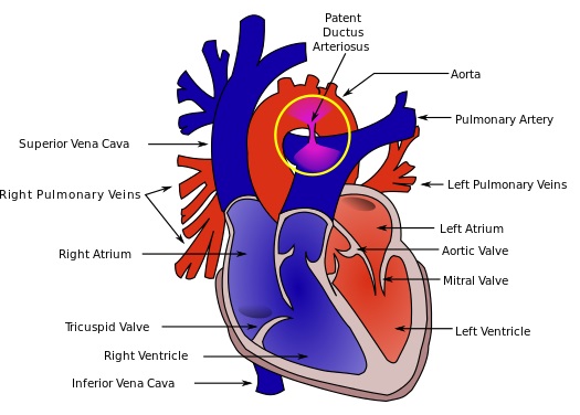 Patent Ductus Arteriosus