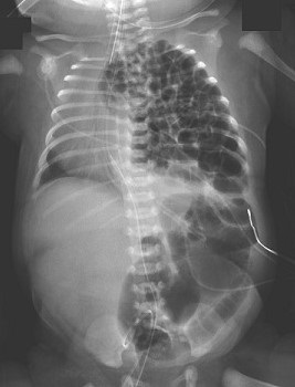 Chest X-ray - Congenital Diaphragmatic Hernia