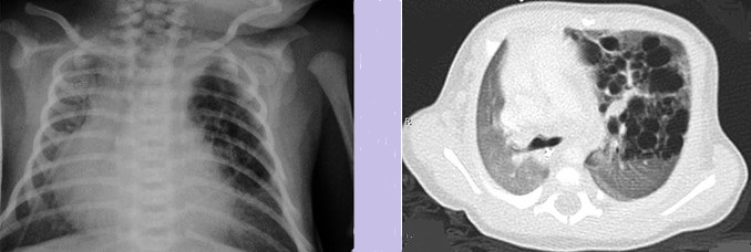 Congenital Pulmonary Airway Malformation