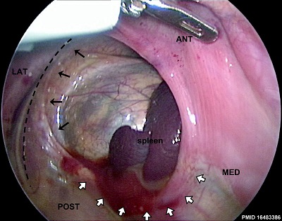 Thoracoscopic View of a Congenital Diaphragmatic Hernia