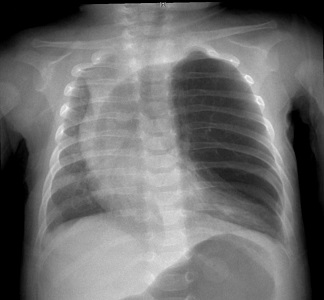 Chest X-ray - Congenital Lobar Emphysema