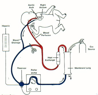 ECMO Circuit