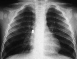 Chest-Xray - Foreign Body