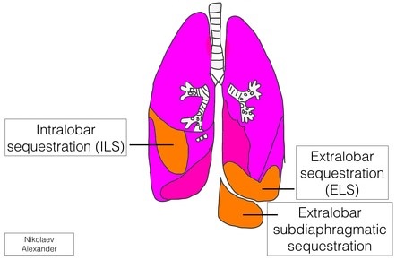 Types of Pulmonary Sequestration