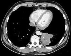 CT Scan - Extralobar Sequestration