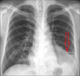 Chest X-ray Extralobar Pulmonary Sequestration