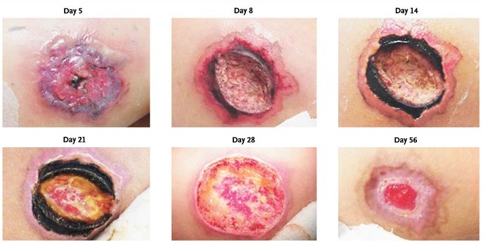 Brown Recluse Bite Stages