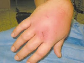 Clenched Fist Injury