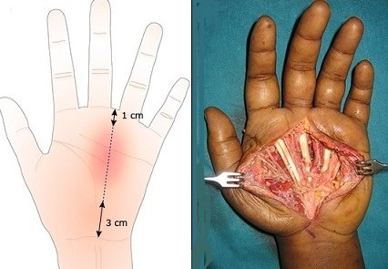 Midpalmar Space Abscess Drainage