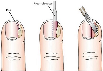 Drainage of a Paronychia