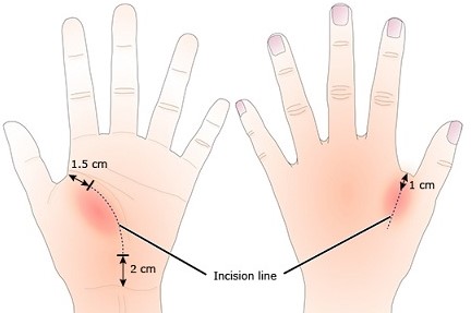 Thenar Space Abscess Drainage