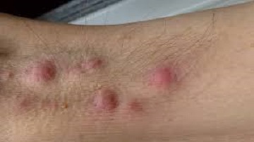 Early Stage Hidradenitis