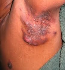 Late Stage Hidradenitis