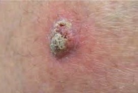 Squamous Cell Skin Cancerr