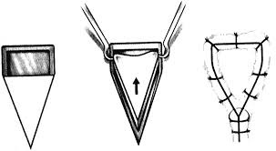 V-Y Advancement Flap