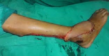 Distal Sural Flap